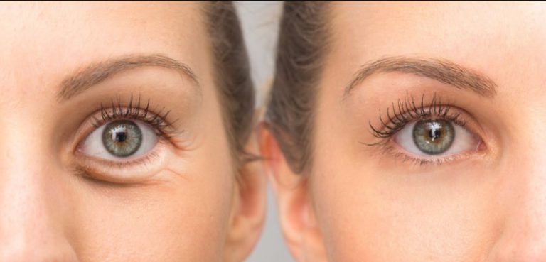 Kenali Faktor Penyebab Munculnya Mata Panda