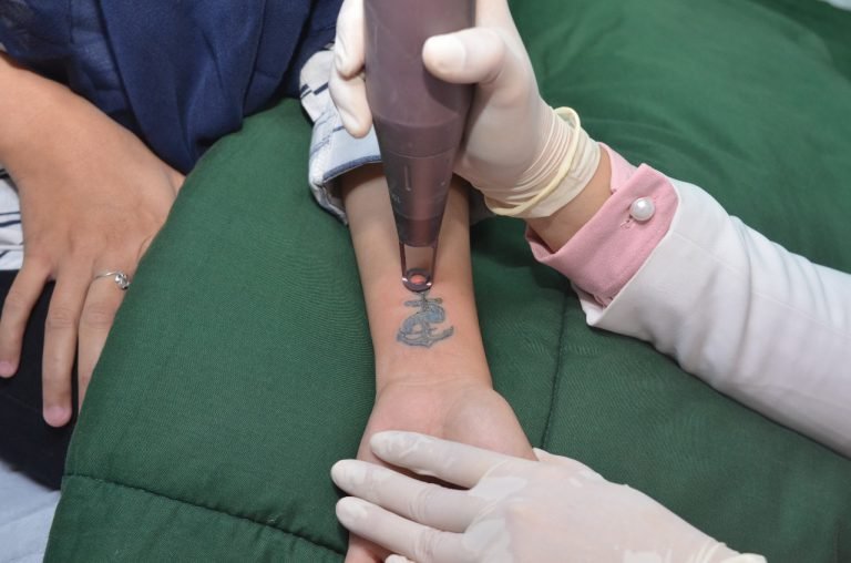 Mantapkan Berhijrah dengan Tattoo Removal dari Hayyu
