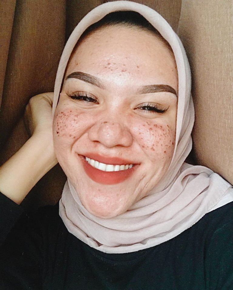 Pejuang Jerawat: You’re Doing Great!